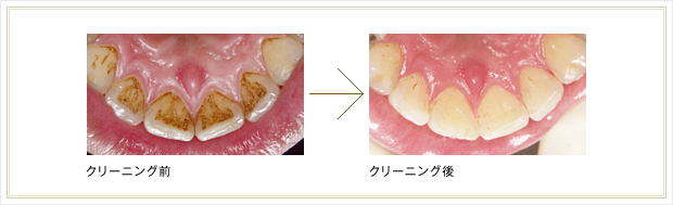 PMTC 歯のクリーニングの写真