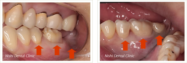 ＢＯＰＴテクニック画像