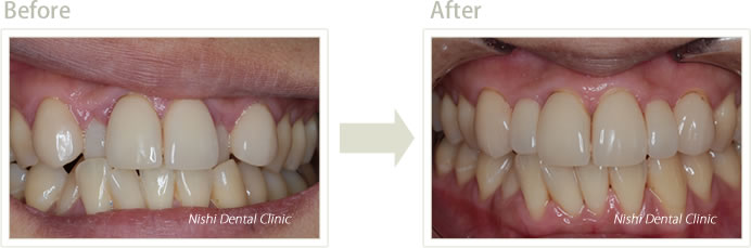 BTAテクニックの施術後