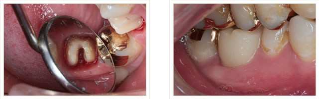 btaテクニックの治療中写真